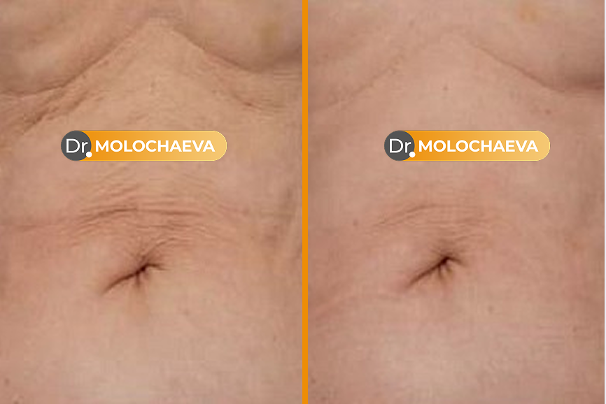 ТЕЛО, живот , колени , руки , ягодицы, внутренняя поверхность бедра
